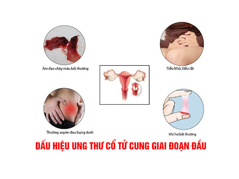 5-dau-hieu-ung-thu-co-tu-cung-de-bi-bo-qua