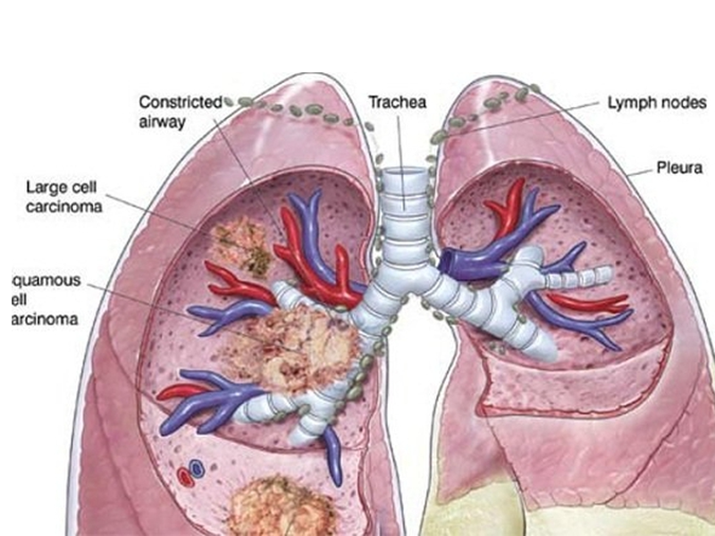 can-benh-ung-thu-am-anh-1-phut-co-3-nguoi-chet