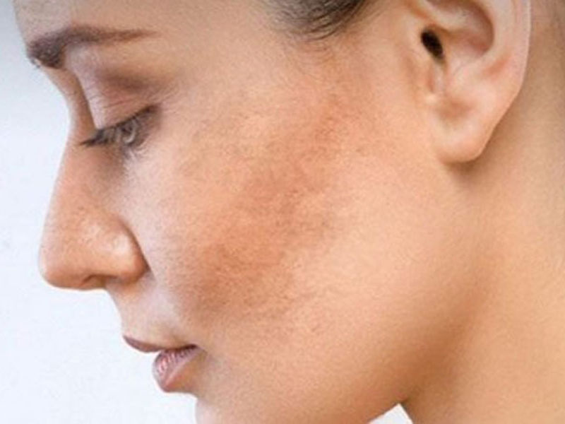 sam-da-co-phai-bi-benh-gan