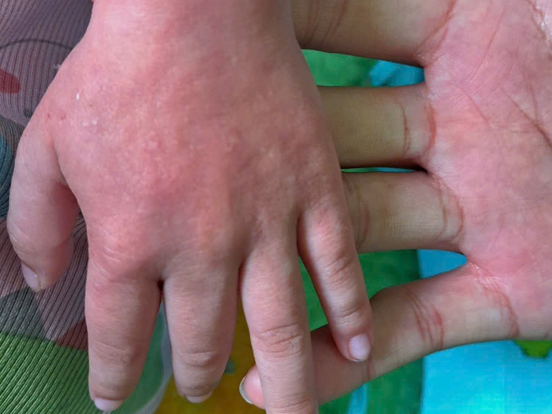 ban-soi-co-ngua-khong-nhung-dieu-quan-trong-can-biet-khi-bi-ban-soi