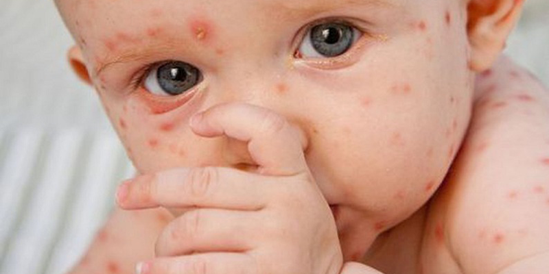 benh-soi-toan-dien-dinh-nghia-nguyen-nhan-trieu-chung-bien-chung-va-giai-phap-phong-ngua