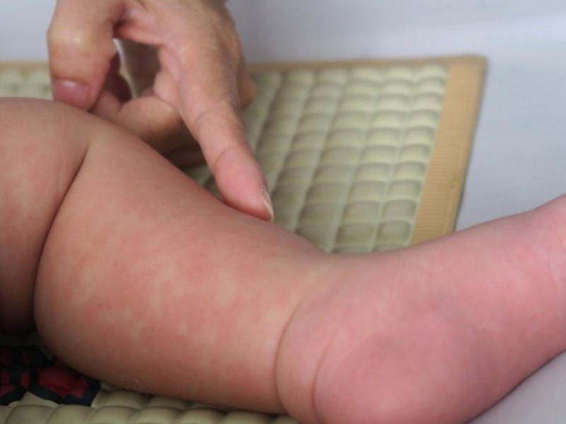 bệnh sởi ở trẻ em